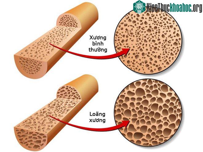 Phụ nữ có nguy cơ bị loãng xương cao hơn nam giới.