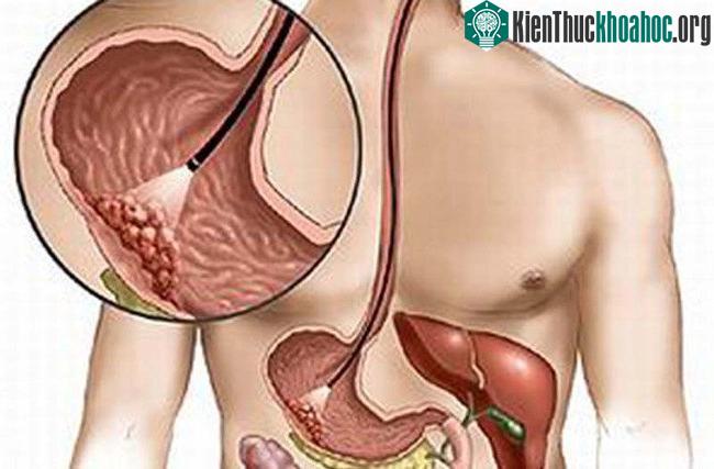 Một số loại ung thư có thể tự “ngụy trang” để lẩn tránh hệ miễn dịch của con người. (Ảnh minh họa: Health).