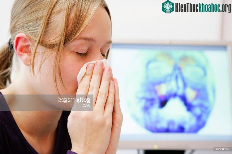 Những người dùng kháng sinh không hợp lý làm cho vi khuẩn kháng lại kháng sinh cũng rất có thể bị viêm xoang.