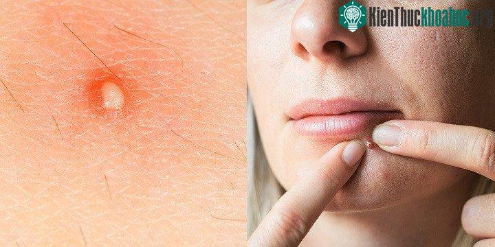 Việc nặn mụn sẽ mở ra cánh cửa để vi khuẩn trên ngón tay của bạn xâm nhập vào mụn.