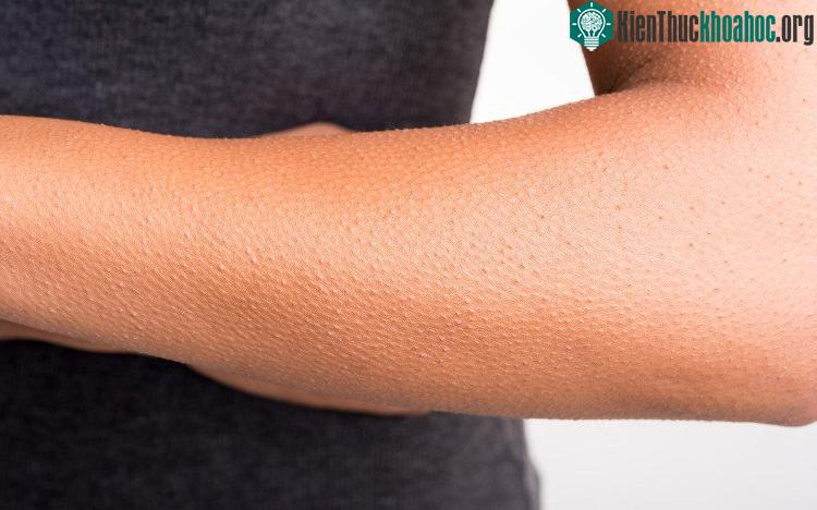 Nổi da gà thường xảy ra khi chúng ta gặp lạnh (bảo vệ thân nhiệt cơ thể), sợ hãi, phấn khích và nhiều dạng cảm xúc khác.