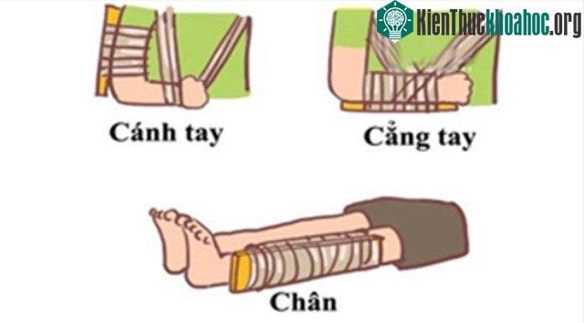 Cách cố định xương gãy. (Ảnh: B.V)