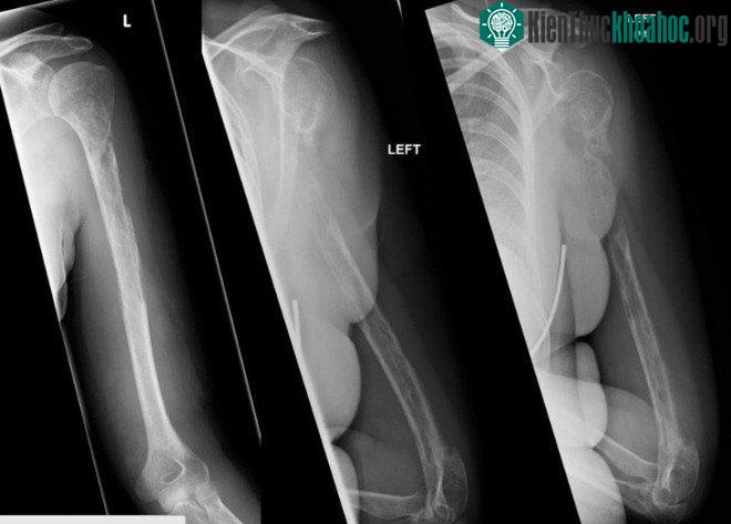 Căn bệnh kỳ lạ khiến xương bệnh nhân "bốc hơi" ngay trước mắt bác sĩ ảnh 0
