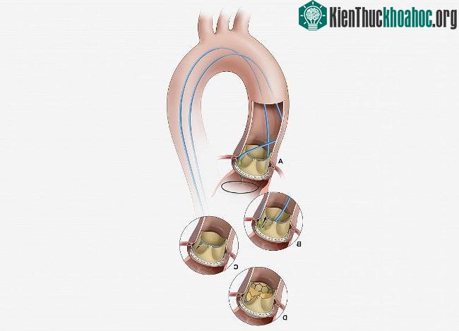 Hẹp động mạch chủ là sự hẹp van gây tử vong kiểm soát máu đi từ tim đến các phần còn lại của cơ thể.