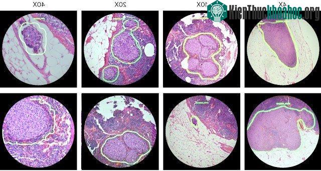Thuật toán AI sẽ phát hiện các tế bào ung thư trong mô, đồng thời khoanh vùng các tế bào này trong hình ảnh thu được từ kính hiển vi.