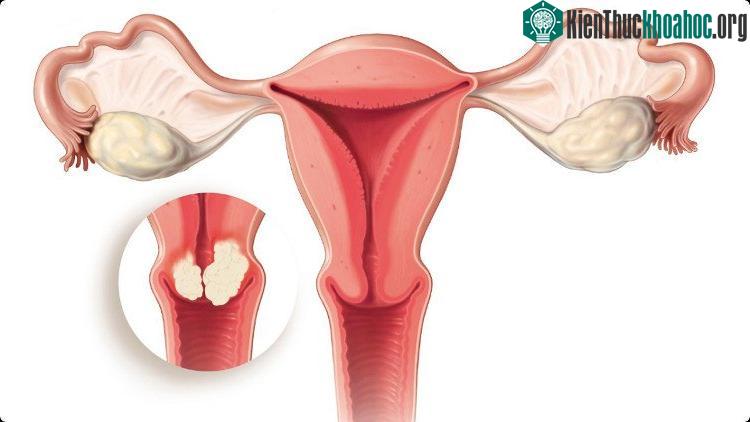 Mỗi năm, trên thế giới có hơn 500.000 ca mắc mới ung thư cổ tử cung.