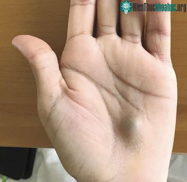 Cục bướu nhỏ ở lòng bàn tay, không ngờ là dấu hiệu của một căn bệnh cực kỳ nghiêm trọng.