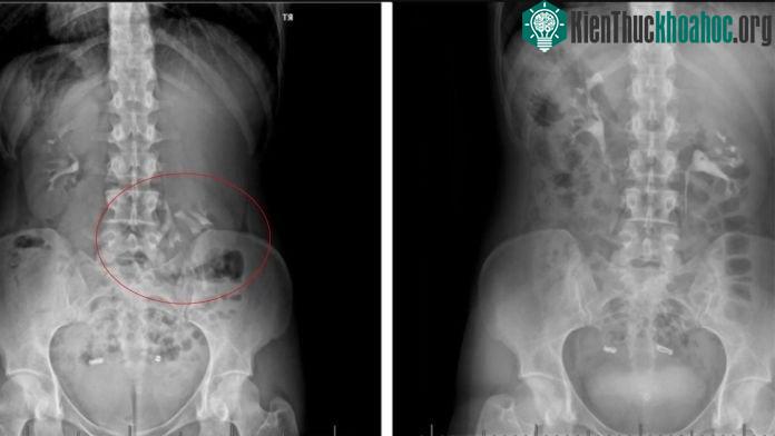 Trong trường hợp bệnh nhân nữ này, thận phải xuống thấp tới 6cm, khoảng cách của hai đốt sống.