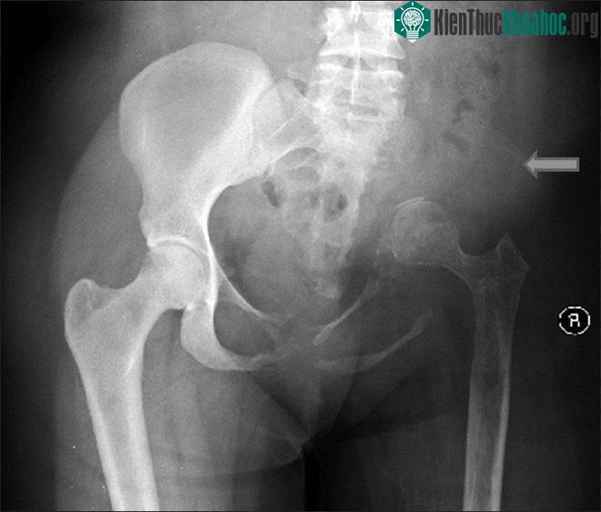 Căn bệnh kỳ lạ khiến xương bệnh nhân "bốc hơi" ngay trước mắt bác sĩ ảnh 1