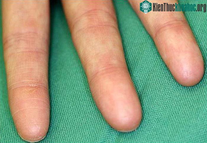 Những người mắc phải căn bệnh adermatoglyphia không có dấu vân tay.