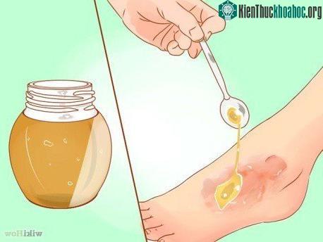 Mật ong chữa thương hiệu quả nhưng giá đắt hơn đường.
