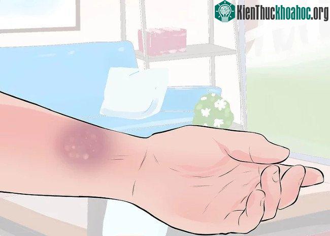 Kiểm tra hiện tượng bầm tím