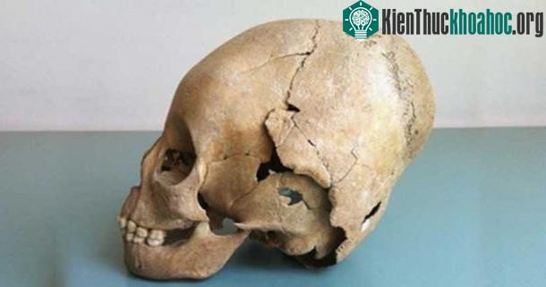 Người ta phải thực hiện tập tục này khi đối tượng còn nhỏ tuổi vì khi ấy hộp sọ còn mềm và dễ thay đổi hình dáng