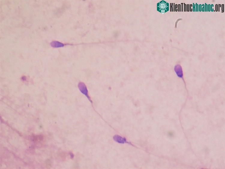 Cấu trúc tinh trùng có thể gây vô sinh, sẩy thai và dị tật bẩm sinh.