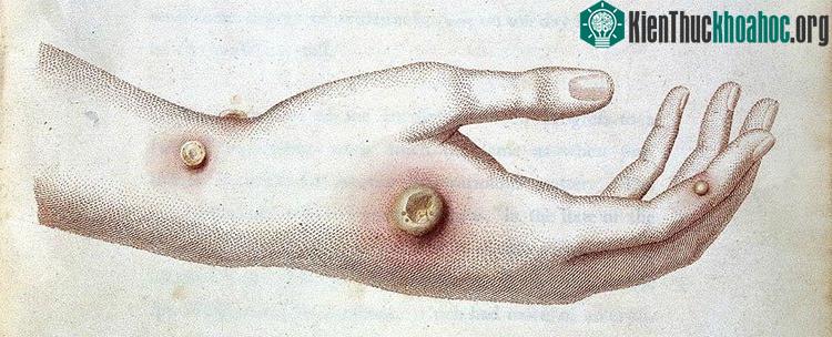 Mô phỏng bệnh đậu mùa bò - cowpox.