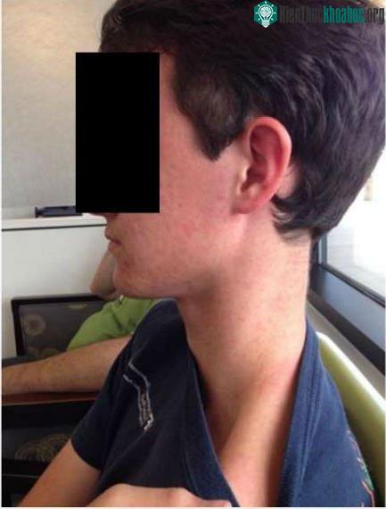 Cơ thể bệnh nhân 16 tuổi phát ban do virus Keystone. (Ảnh: Clinical Infectious Disease).