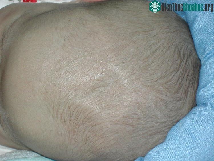 Thóp trước lõm có thể trẻ đang thiếu nước.