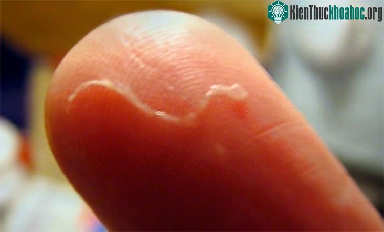 Việc con người nhiễm loài giun chỉ D. repens là tương đối hiếm.