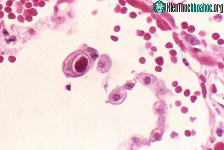 Loại virus Cytomegalo trở nên đặc biệt phổ biến ở người lớn tuổi.