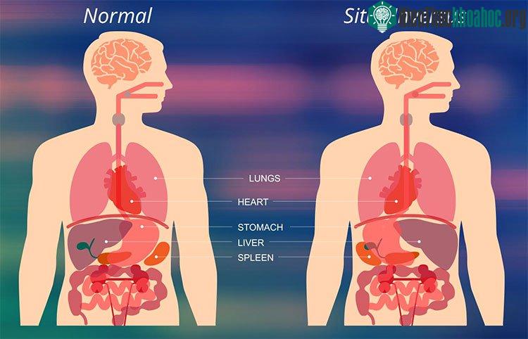 Người bình thường (trái) và người bị đảo lộn nội tạng (phải).