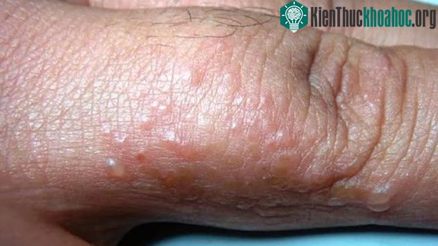 Ghẻ nước là bệnh ghẻ hình thành nên các mụn nước do ký sinh trùng ghẻ gây ra.