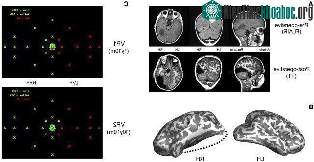 Ảnh chụp fMRI cho thấy U.D. bị khiếm khuyết mất 1/3 bán cầu não phải.