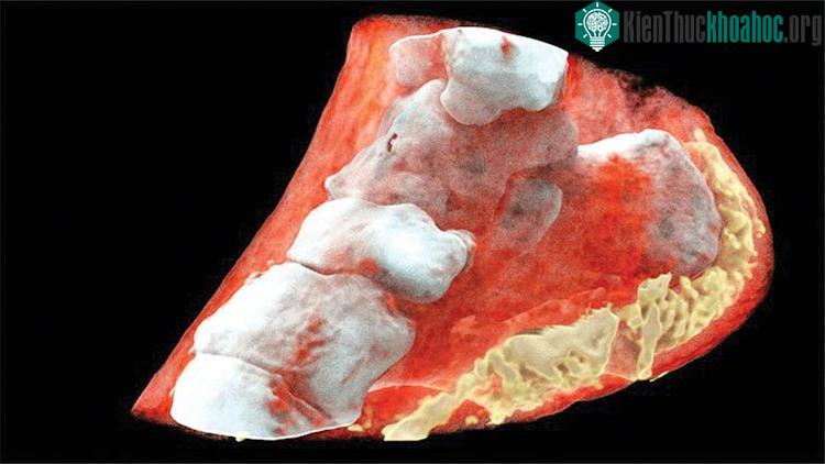 Máy quét có thể phân biệt giữa xương, cơ, chất béo, chất lỏng và mọi loại vật liệu khác trong cơ thể con người.