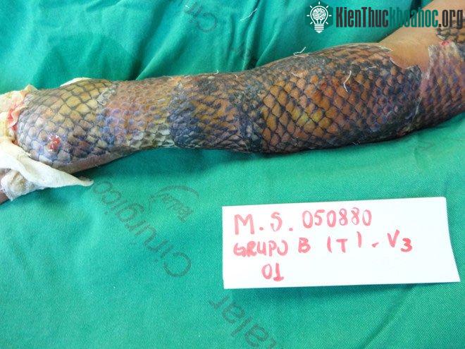 Các vết thương do bỏng của Maria Ines được điều trị bằng da cá rô phi. (Ảnh: Yahoo).