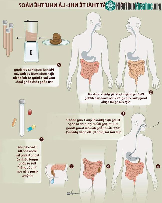 Quy trình cấy ghép chất thải tế nhị.