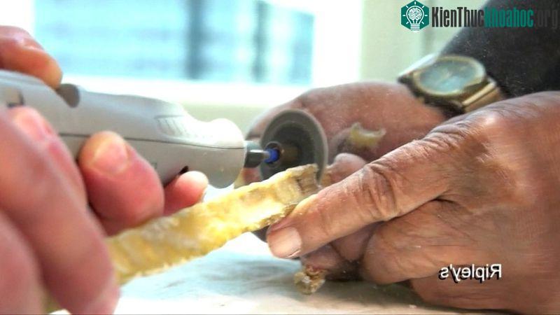 Từng móng tay được cắt ra bằng một chiếc cưa nhỏ và quá trình thực hiện kéo dài 20 phút.