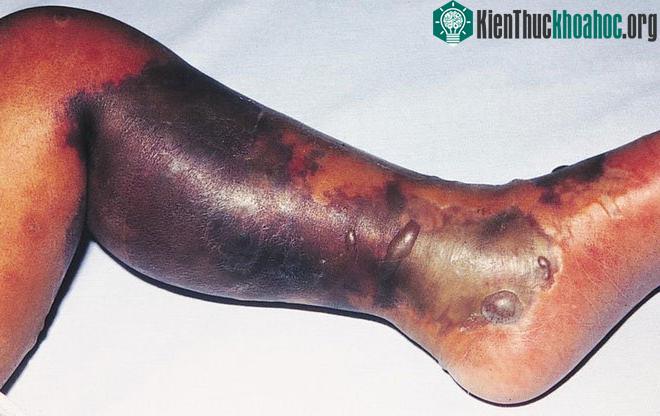 hvKp có thể biến thành khuẩn ăn thịt người , gây hoại tử nghiêm trọng.
