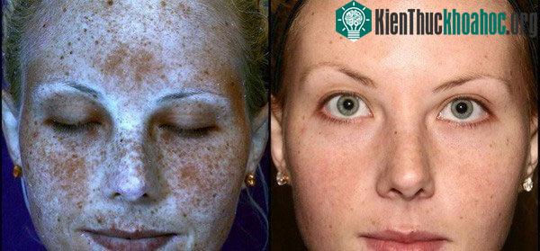 Việc tiếp xúc với ánh Mặt trời sẽ khiến da gặp thương tổn ngày càng nghiêm trọng.