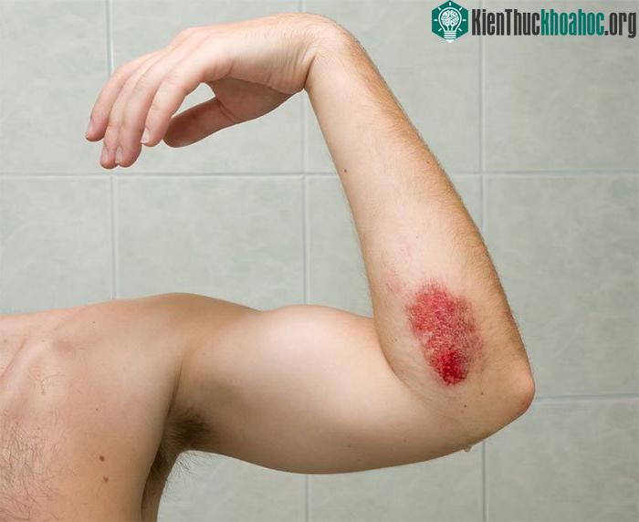 Để loại trừ nguy cơ vi khuẩn ăn thịt người tấn công, bạn cần tránh ra biển khi có vết thương hở.