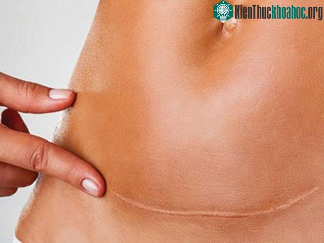 Giữ vệ sinh vết mổ sạch và khô ráo, chỉ nên dùng xà bông và nước để rửa.