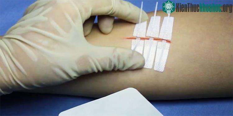 Dụng cụ này có thể được sử dụng thay thế cho băng dính và keo dán y tế trong nhiều trường hợp.