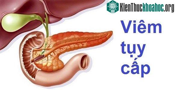 Viêm tụy cấp là chứng viêm (sưng) ở tụy và thường xảy ra đột ngột.