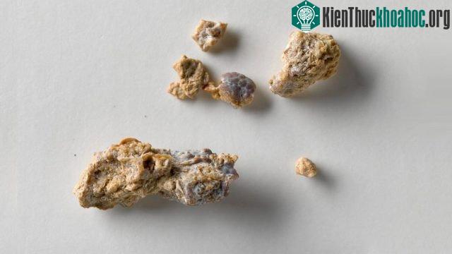 Sỏi thận phản ánh về sức khỏe và chức năng của thận