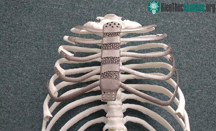 Các bác sĩ đã tái tạo lồng ngực thành công cho bệnh nhân.
