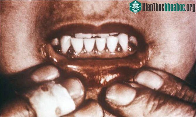 Khi trở nặng, bệnh có thể gây sưng, chảy máu nướu răng, cơ thể bị bầm tím...