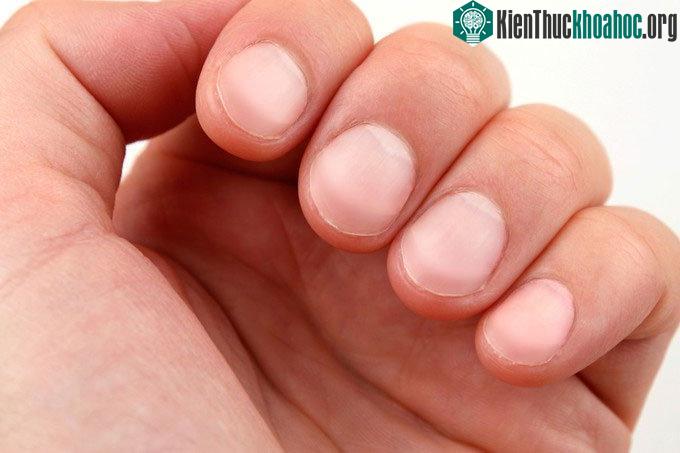 Màu sắc của móng tay cảnh báo nhiều bệnh tật.