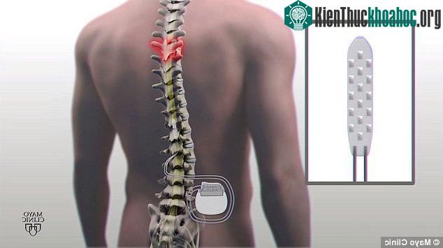 Các điện cực được gắn vào phần cột sống bị tổn thương, với dây kết nối với pin đặt tại dạ dày.