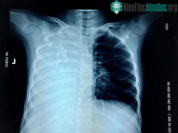 Đây là một khối u cực hiếm và thuộc loại giáp biên ác tính không đáp ứng với hóa trị.