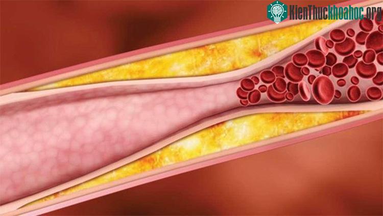 Máu nhiễm mỡ còn được gọi với tên gọi khác là rối loạn chuyển hóa lipid máu hay mỡ máu cao.