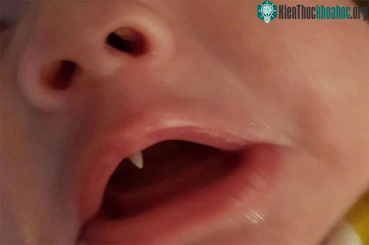 Chiếc răng nanh như Dracula của Oscar. (Ảnh: GĐCC).
