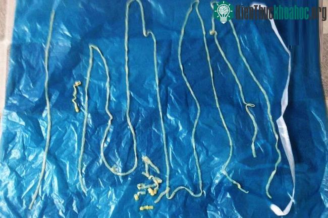 Tùy thuộc vào vị trí ký sinh của nang sán mà có những biểu hiện khác nhau.