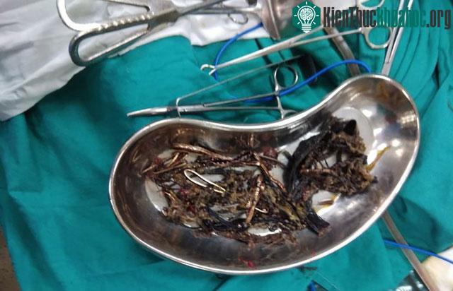 Rất nhiều kim loại gồm các vật sắc nhọn được tìm thấy trong dạ dày một người phụ nữ ở Ấn Độ