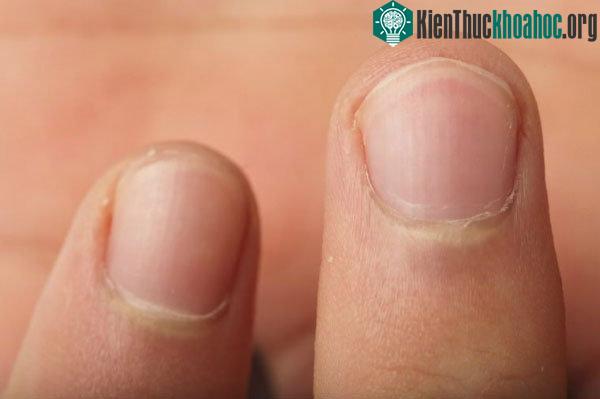 Cắn móng tay khiến răng dễ bị mòn, men răng nhiều vết nứt, khớp cắn bị sai vị trí. (Ảnh: Rd).