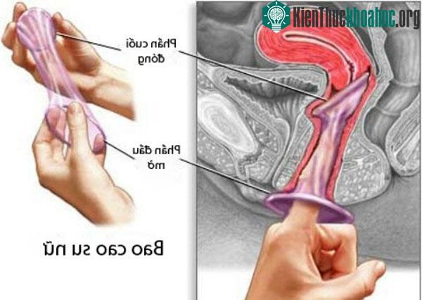 Giá một bao cao su nữ cao hơn bao cao su nam. (Ảnh: NHS).
