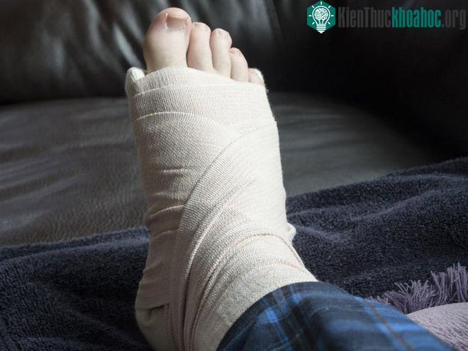 Một người bị gãy ngón chân út nhưng vẫn phải bó bột.