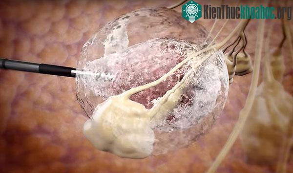 Các bác sĩ sẽ luồn một ống kim loại vào ngực của bệnh nhân để tiêu diệt khối u bằng cách đóng băng nó.